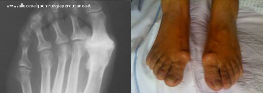 alluce rigido pre e post intervento