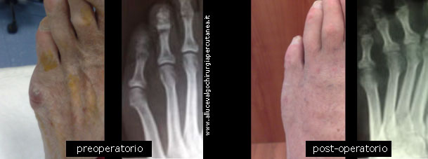 foto pre e post operatorio 5 metatarso varo