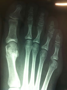 radiografia - alluce valgo - chirurgia percutanea